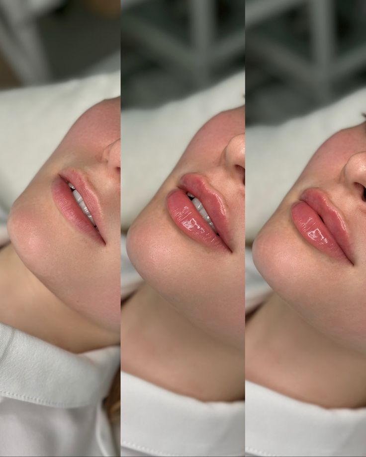 Evolução do preenchimento labial em três etapas